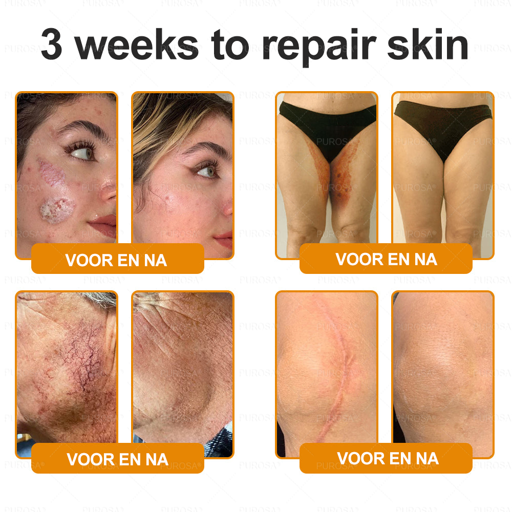 PUROSA® Bijengif Huidherstellende Crème